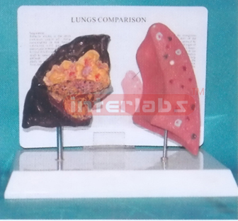 HEALTH AND DISEASE LUNGS COMPARISON MODEL